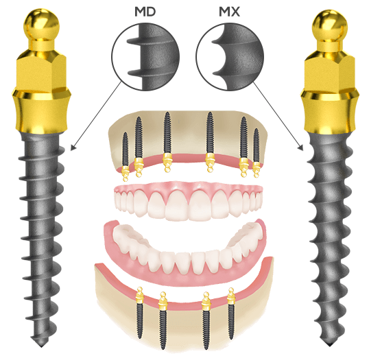 The Nanoplant Implants can be applied in the case of removable toothworks with inserting 2-6 implants.