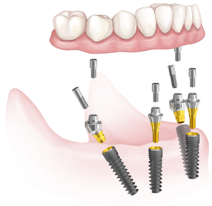 BIONIKA Eco Implant All-on4 solution