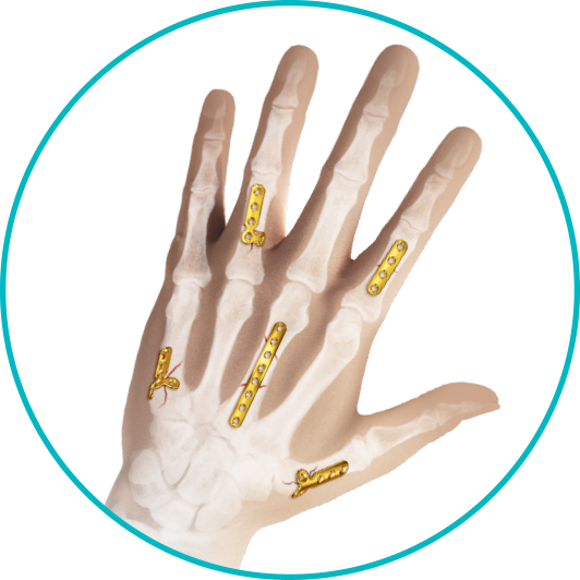 Hand surgical plates of the BIONIKA KLS system