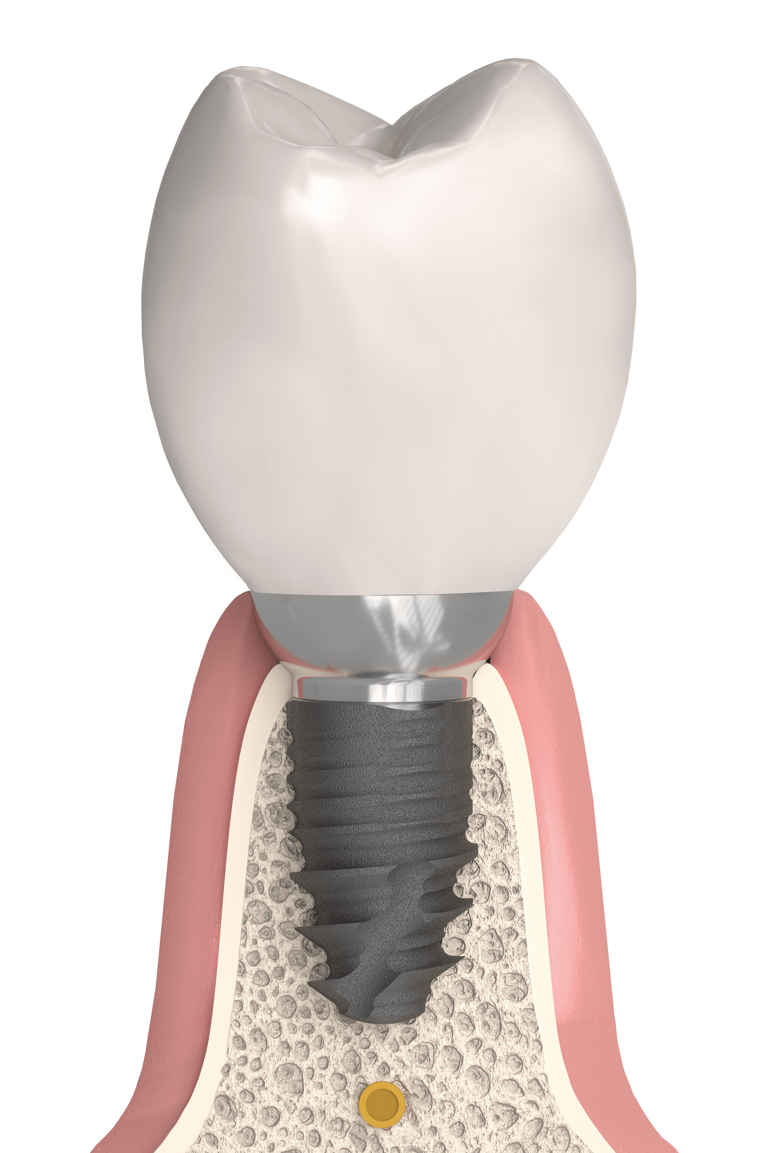 cortilog-short Cortilog short implantátum rendszer, Cortilog short kétfázisú implantátum