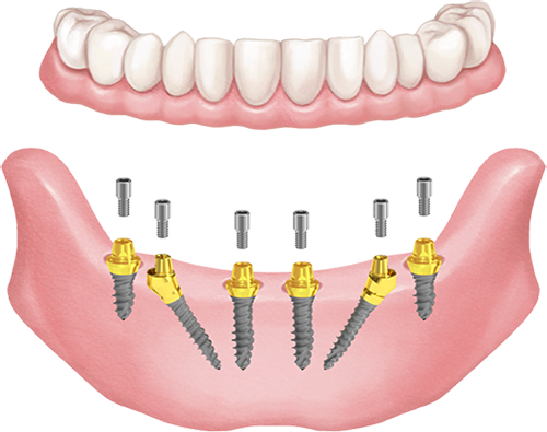 Extra stabil All-on-6 megoldás mini Hybrid implantátumokkal.