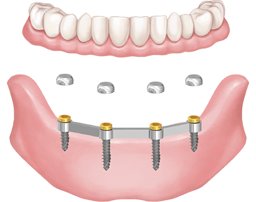 Removable denture solution with bar retention, Hybrid mini implant and locator head.
