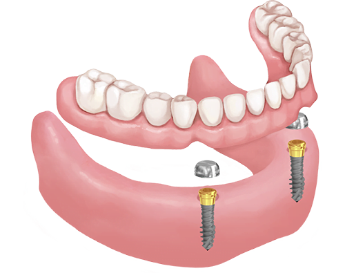 Removable denture solution with Hybrid mini implant and locator head.