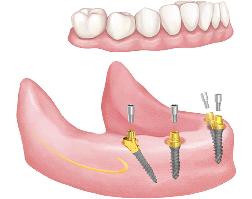 Screw-retained All-on-4 solution with Hybrid mini implants and multi-unit abutments.