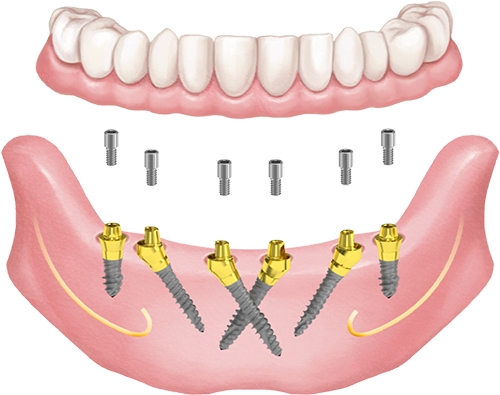 Screw-retained X-Cross solution with Hybrid mini implants and multi-unit abutments. The two anterior implants are placed in a crossed direction relative to each other.