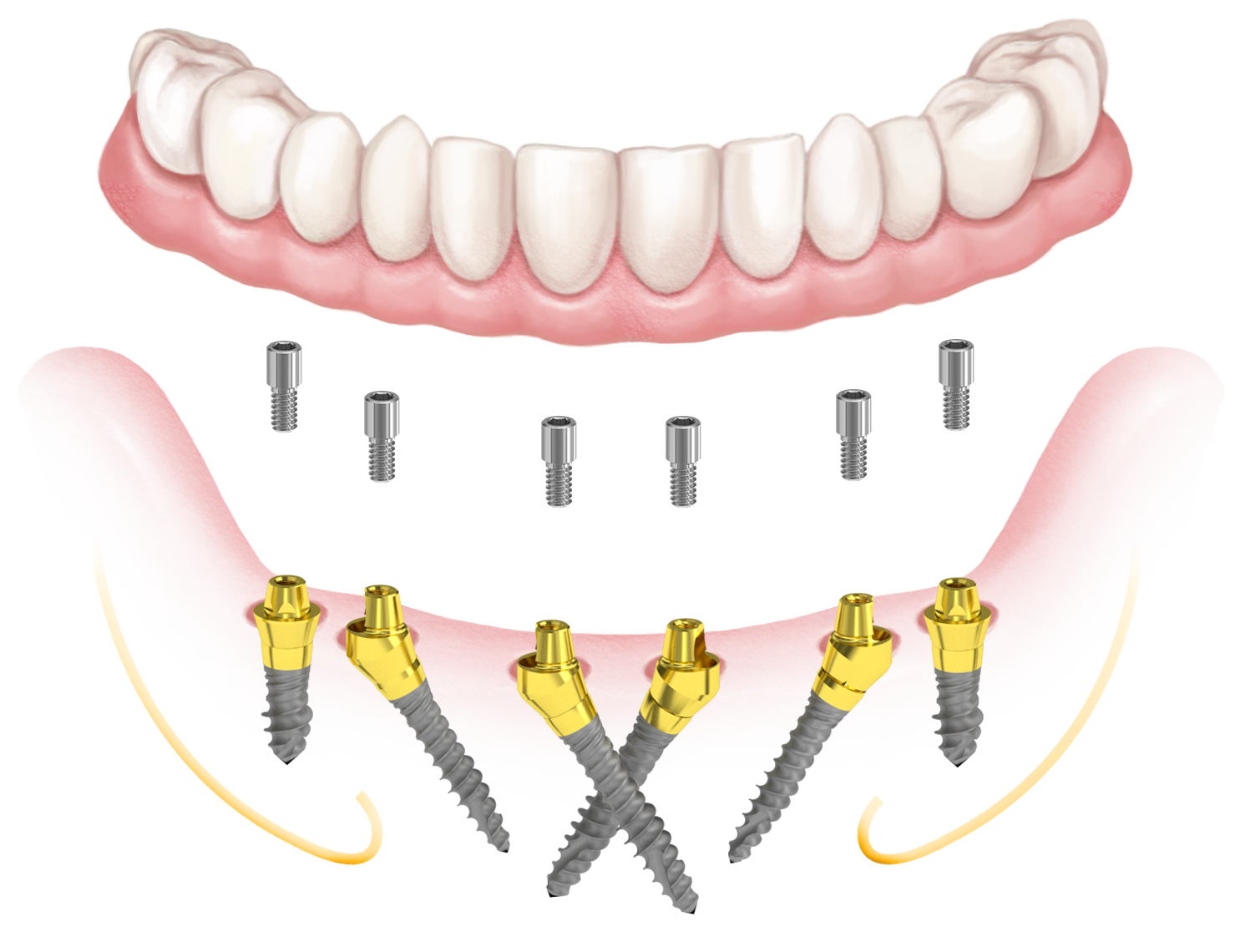 a--on-6 x-cross megoláds mini hybrid implantokkal
