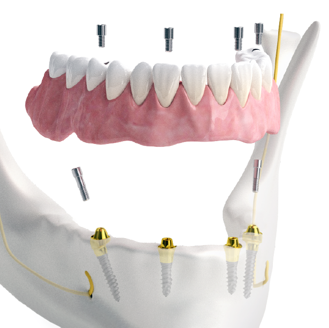 Csavarozozz All-on-4 megoldás BIONIKA implantátumokkal és felépítményekkel.