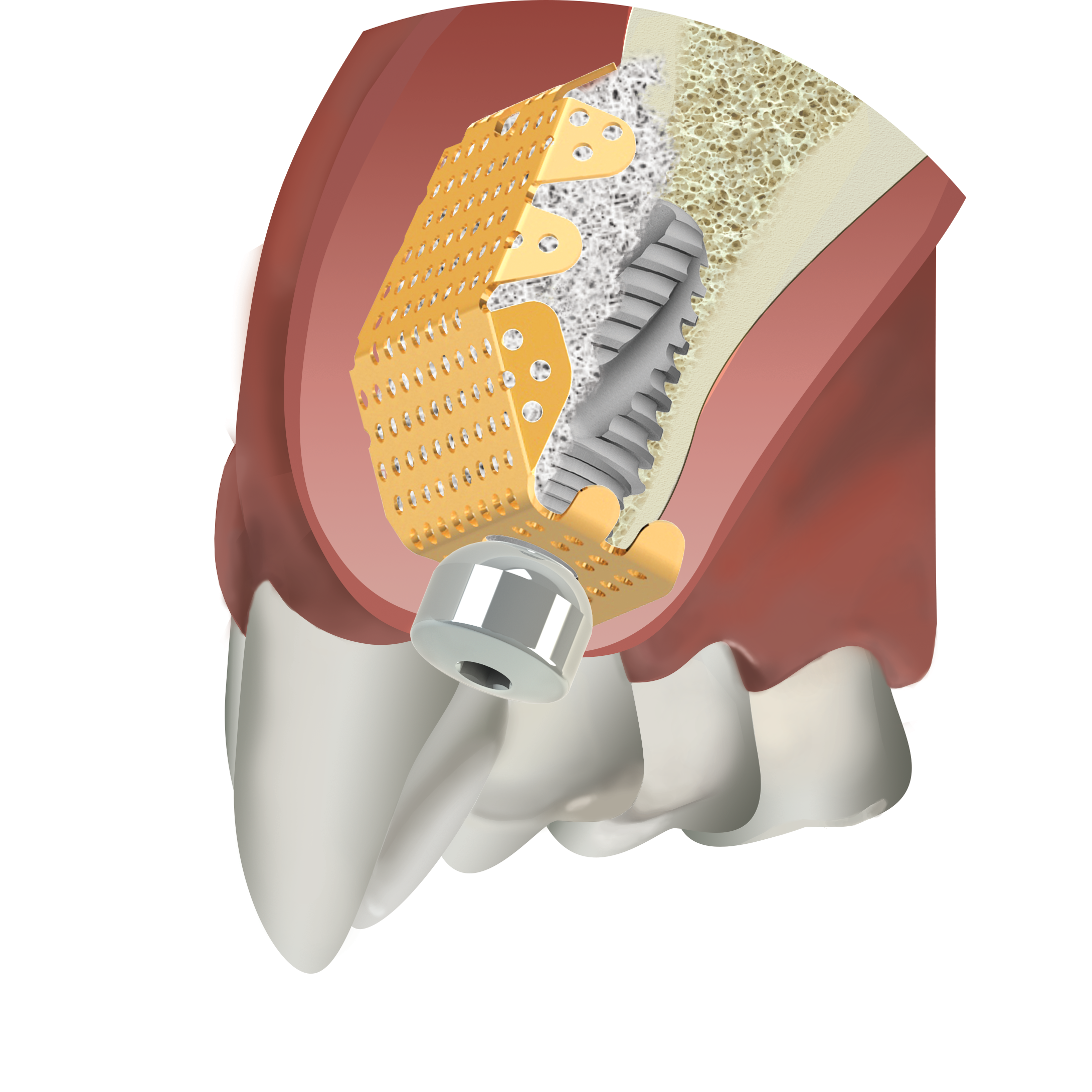 The usage of BIONIKA Special membrane nodes in order to keep the bone substitute material in one place.