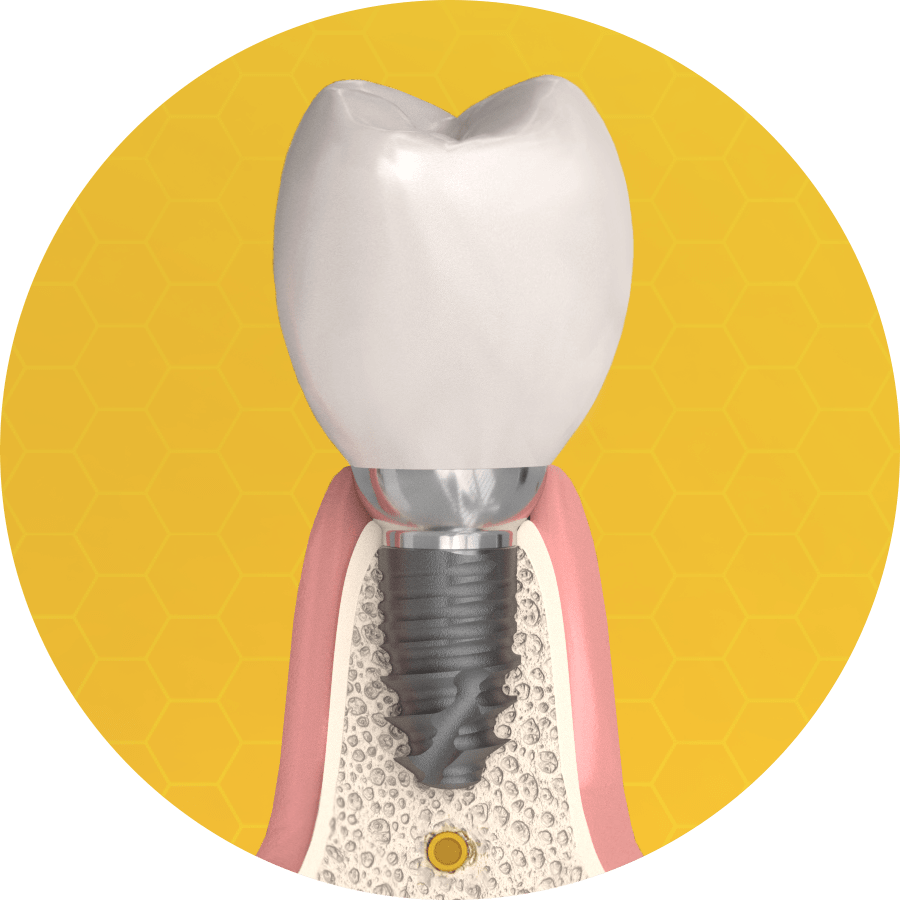 Cortilog Short extra rövid implantátum alkalmazása alacsony csontkínálatnál, az idegcsatorna miatt kevés hely áll rendelkezésre, de a short implantátum megoldást nyújt a problémára.