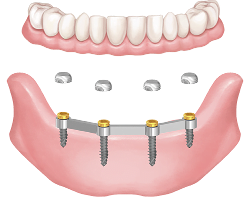 Megoldás kivehető fogsorra sínes rögzítéssel, Hybrid mini implantátummal, lokátorfejjel.
