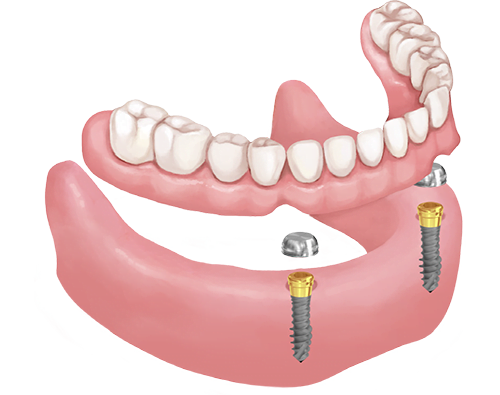 Megoldás kivehető fogsorra Hybrid mini implantátummal, lokátorfejjel.