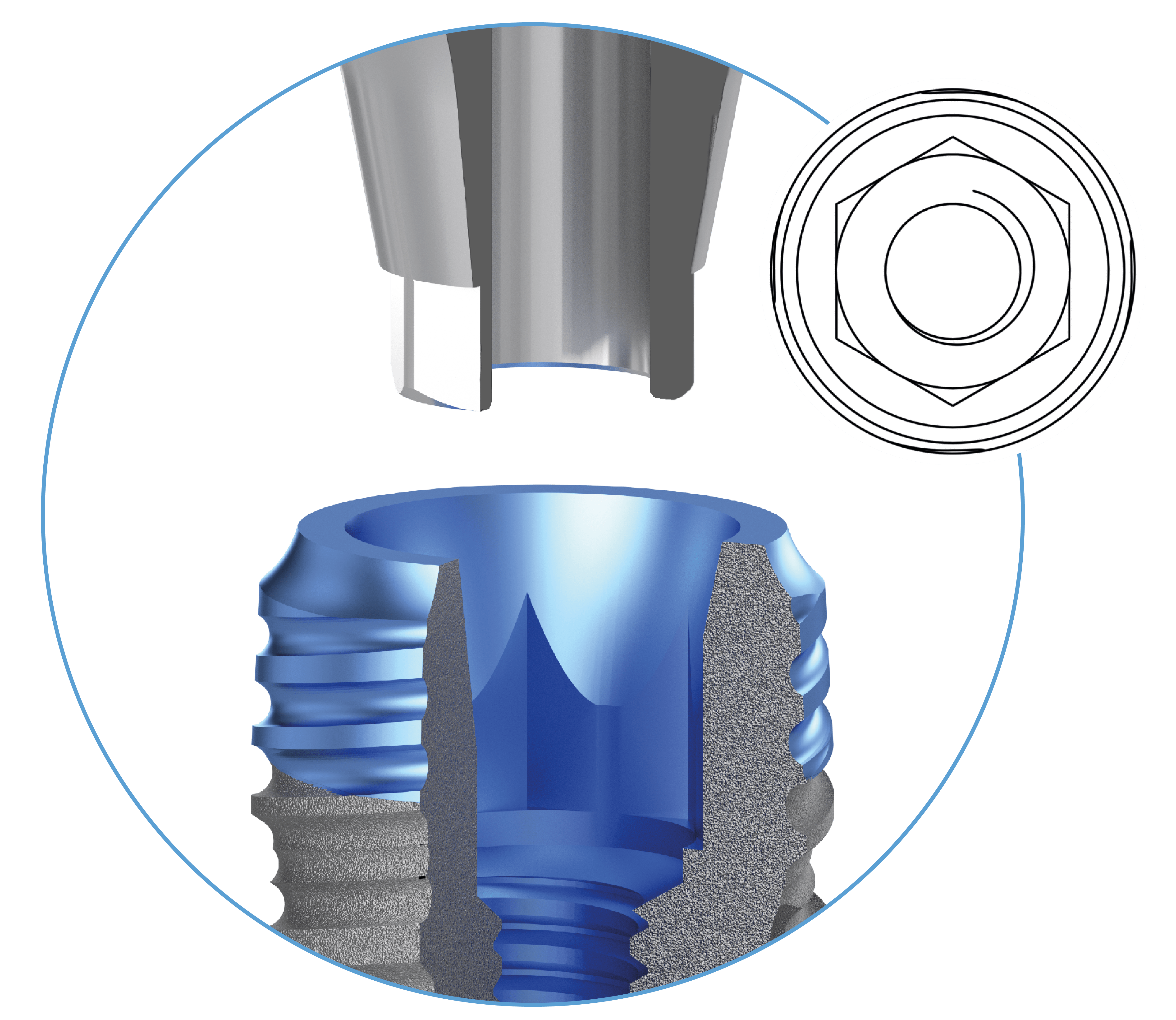 BIONIKA ACtival Implant System csatlakozás, mely Nobel Active ® kompatibilis.