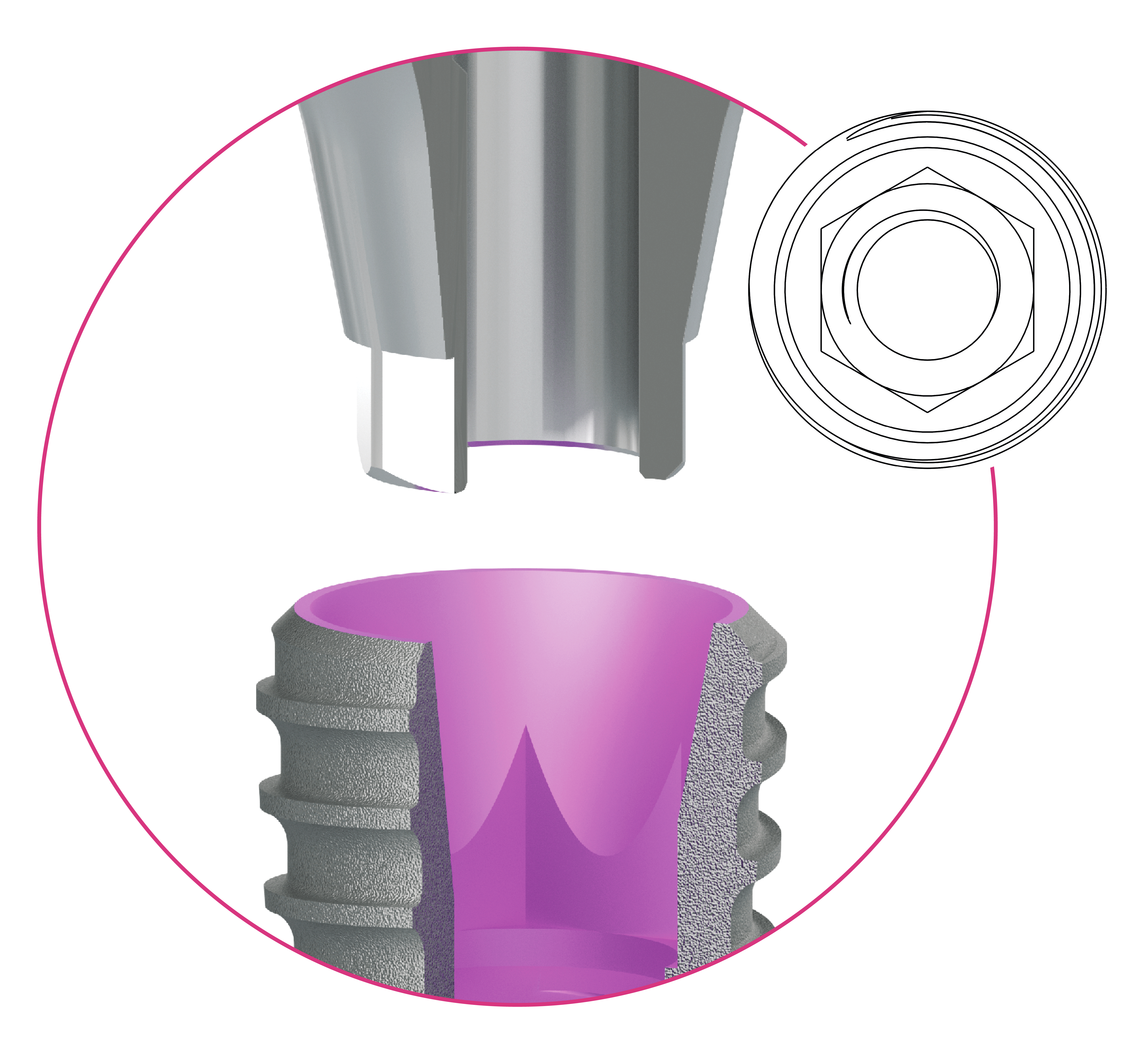Corticon Conical Connection, 3 bütyökformával