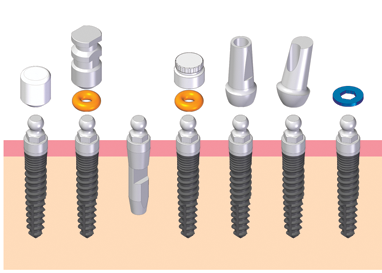 The elements of the Nano telescope are the implants, o-ringed cap, technical implant, sampling head, healing cap, anatomical heads( straight and oblique) 