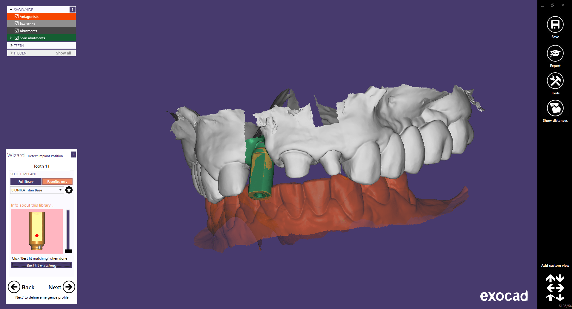scanbodyráillesztés2 CAD-CAM3