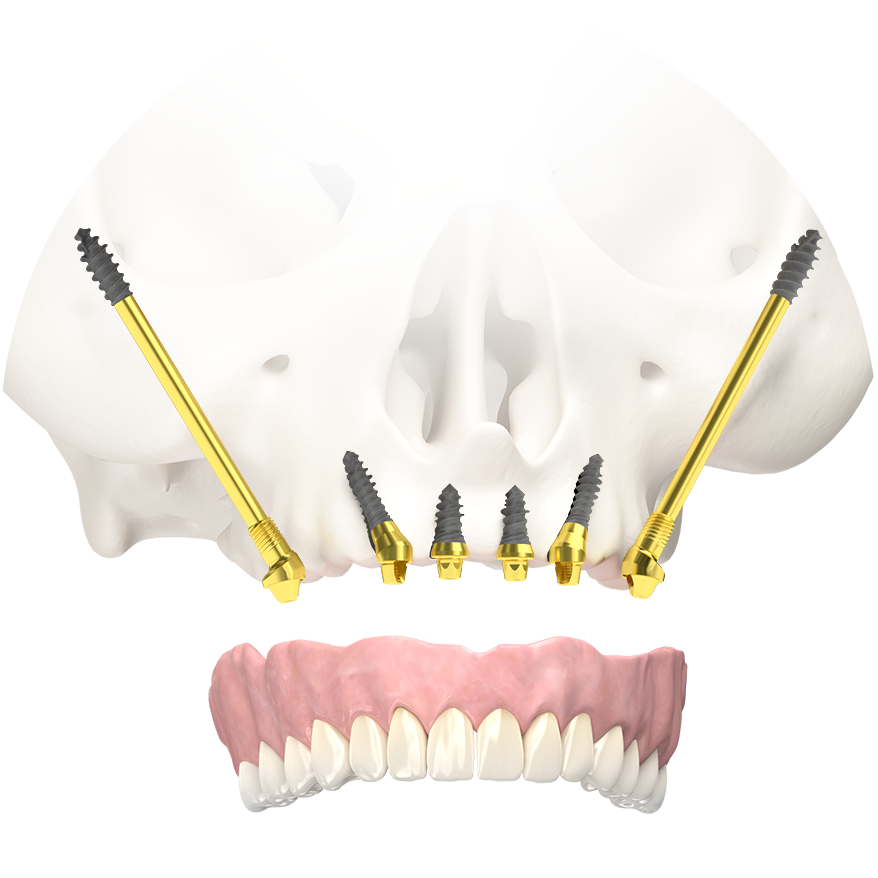 Zygomat implants implanted into the yoke bone, combined with normal implants in the illustration. 